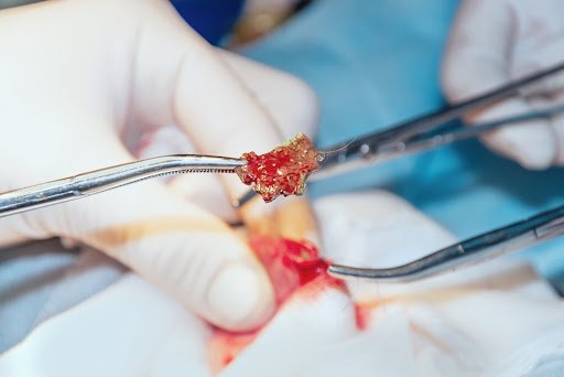 Foreign Body Removal
